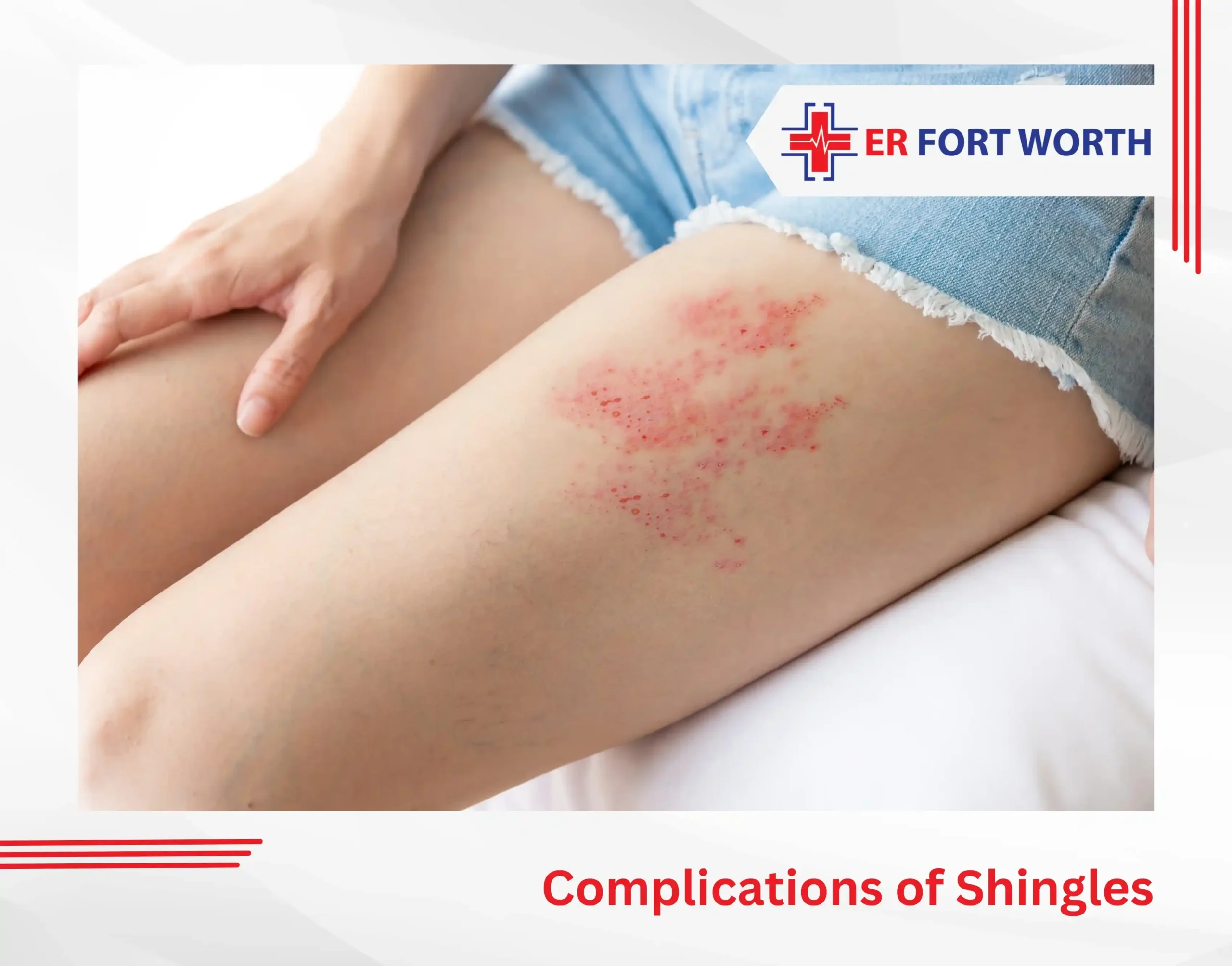 Complications of Shingles