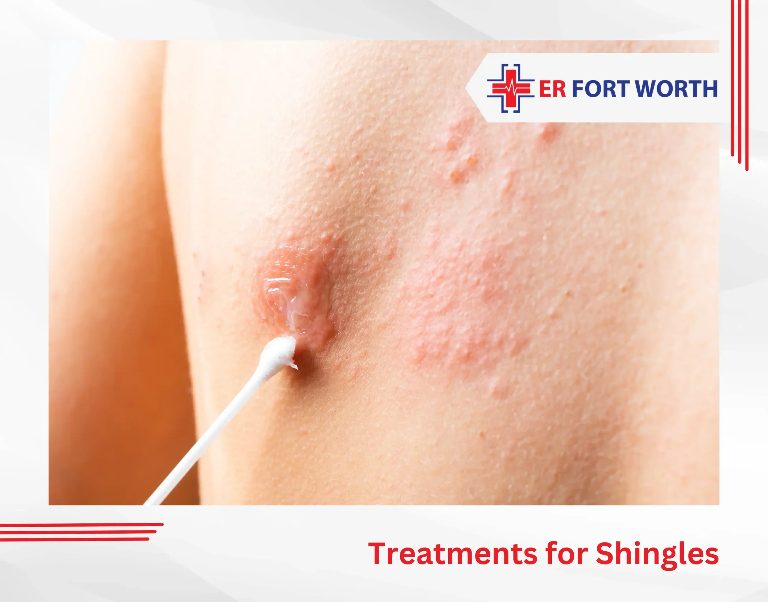 Treatments for Shingles