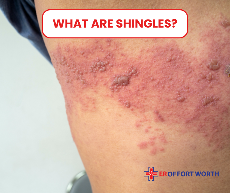 Shingles: What Does it Look Like : Signs, Causes & Treatment