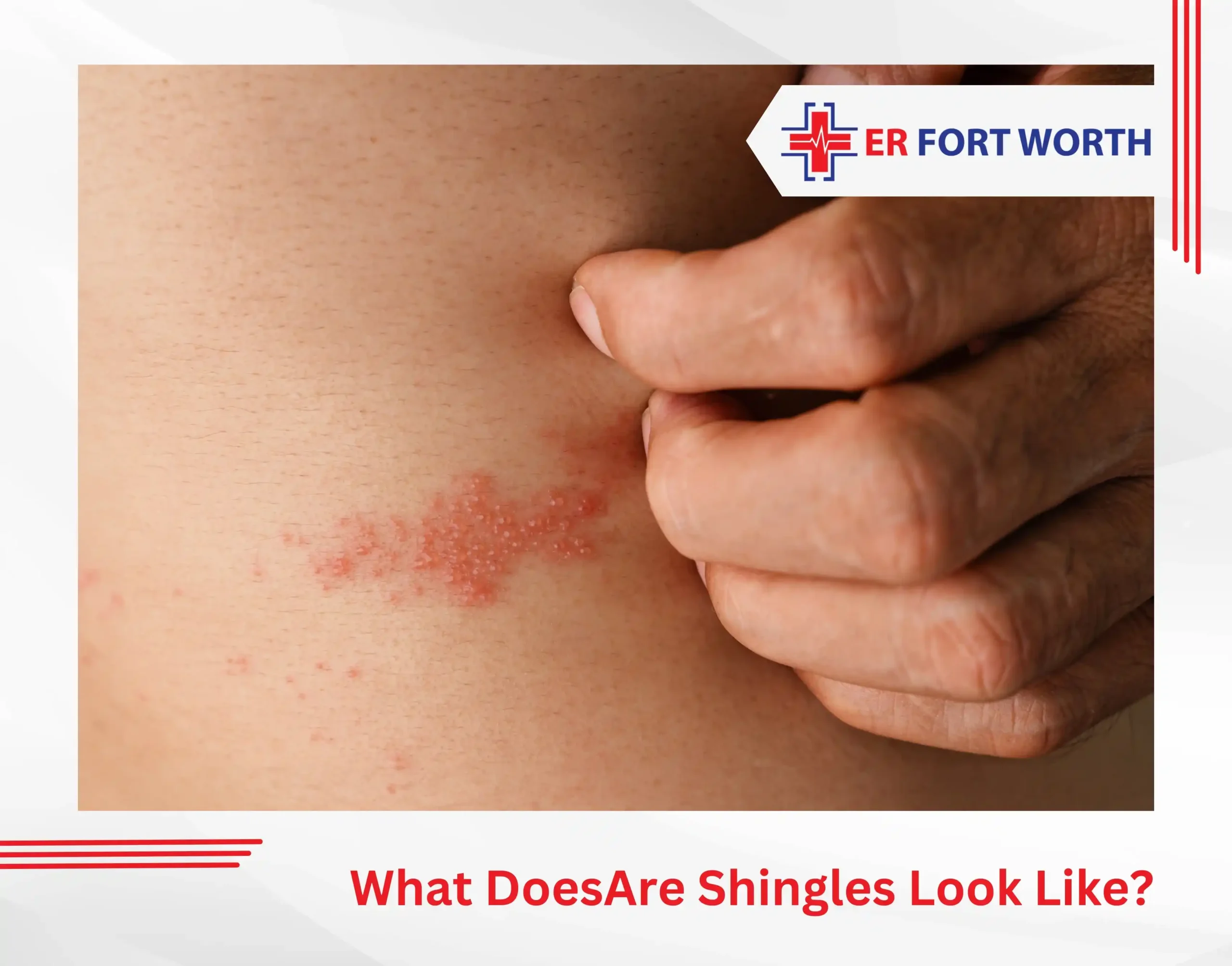 What Does Shingles Look Like