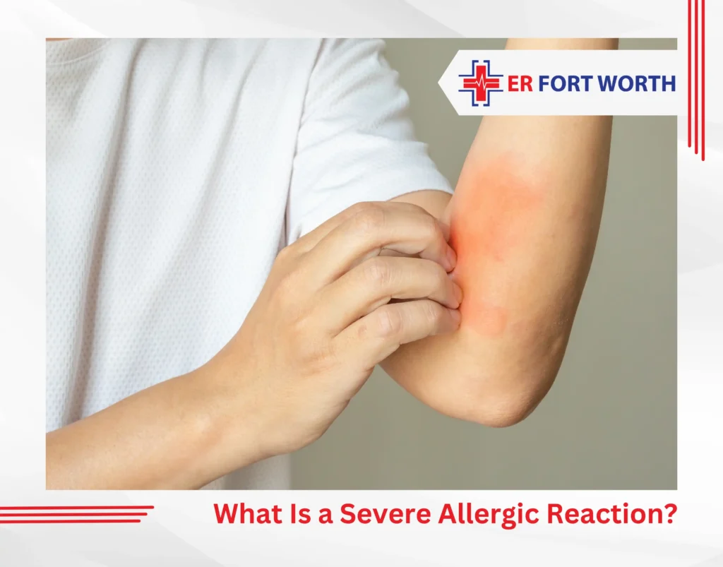 What Is a Severe Allergic Reaction