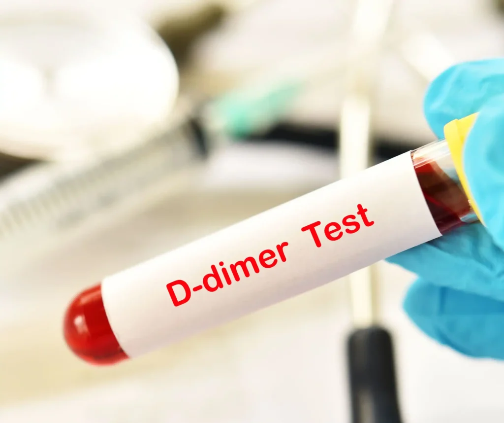 D-dimer Test