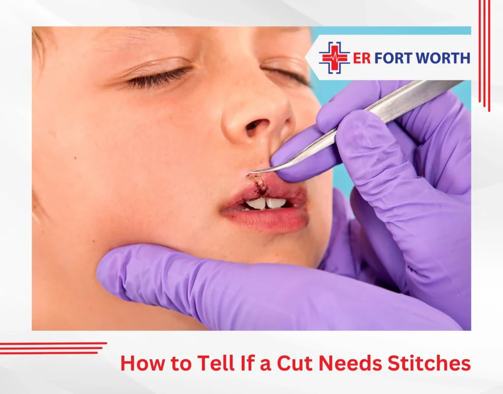 How to Tell If a Cut Needs Stitches