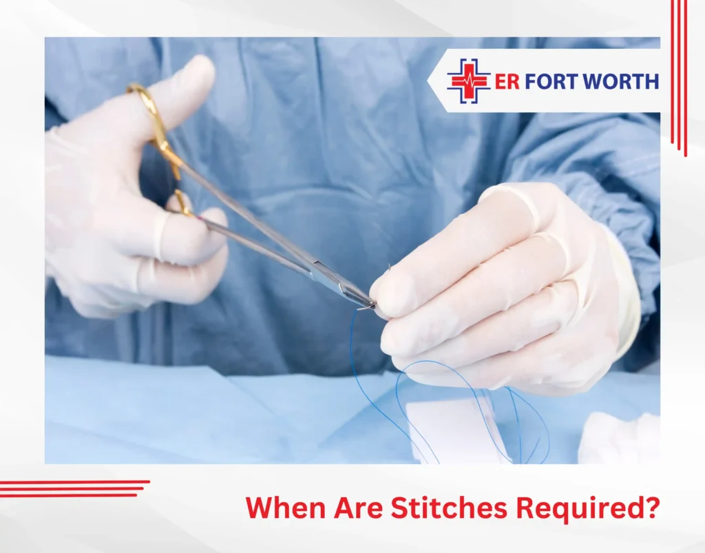 When Are Stitches Required