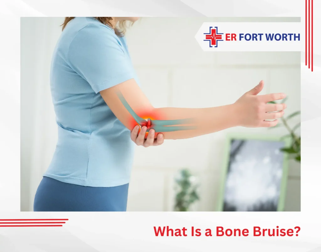 What Is a Bone Bruise