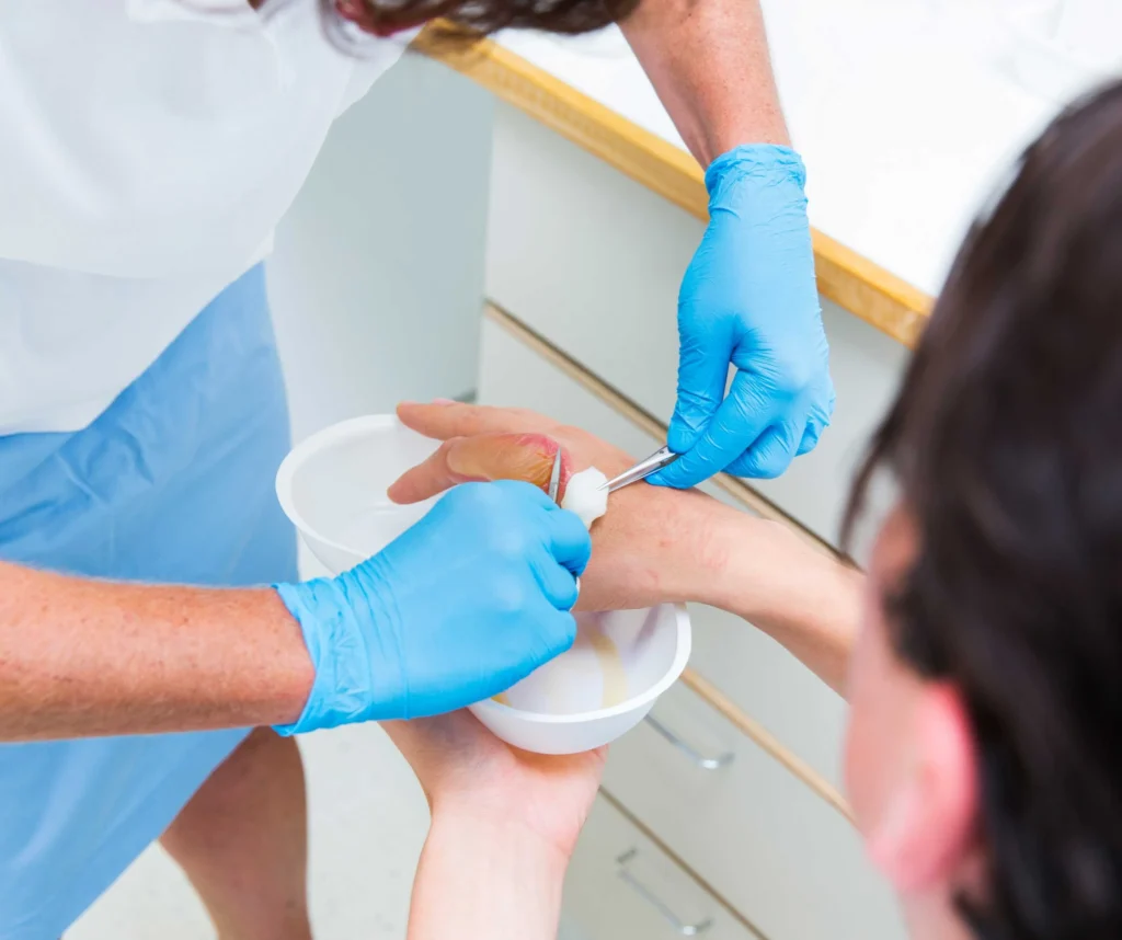 Burns Treatment Emergency Care at ER of Fort Worth