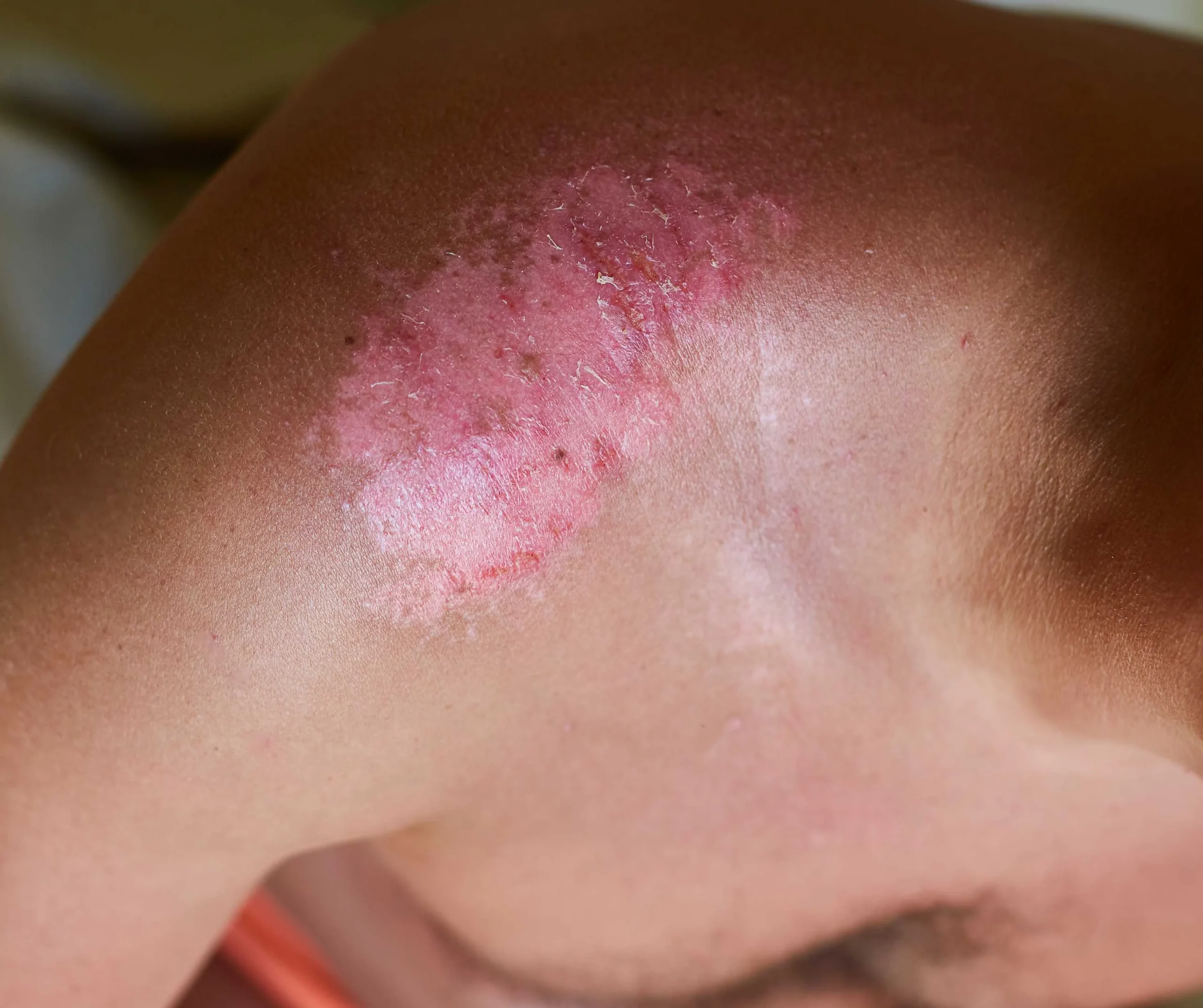 Third-degree and Severe Burns