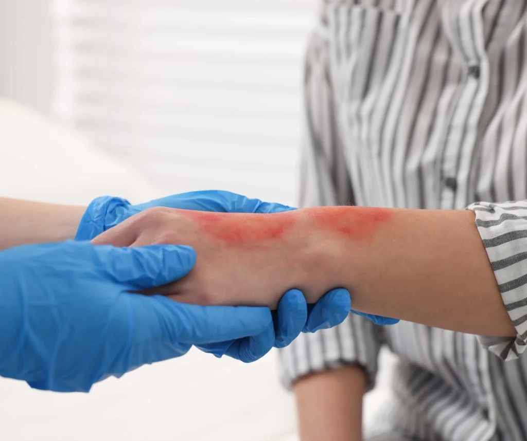 When to Visit the ER for Burns