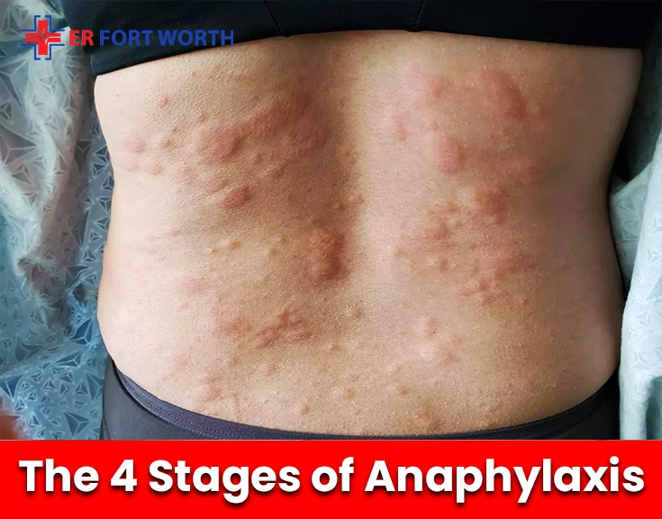 The 4 Stages of Anaphylaxis