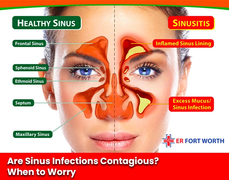 Are Sinus Infections Contagious When to Worry?