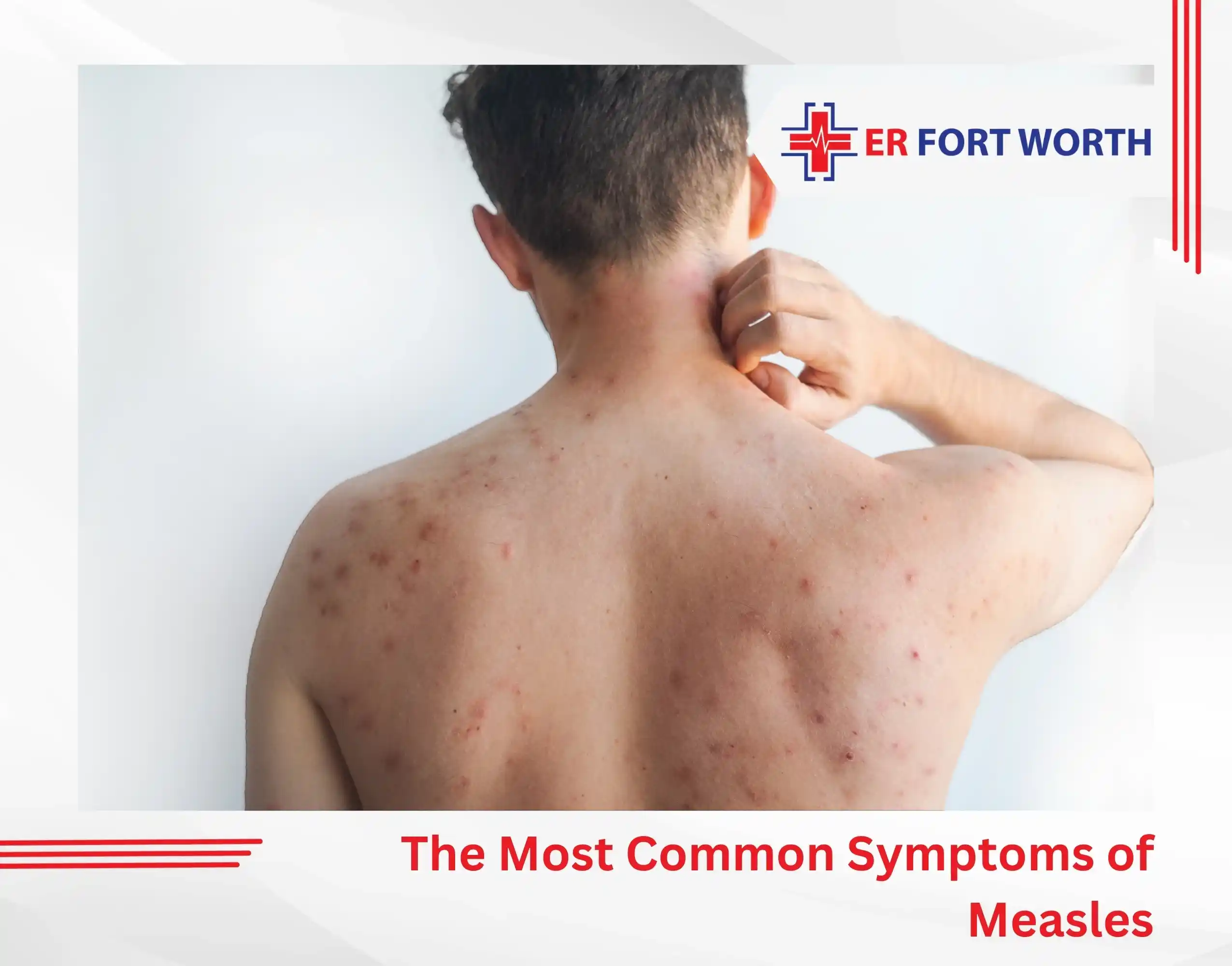 The Most Common Symptoms of Measles