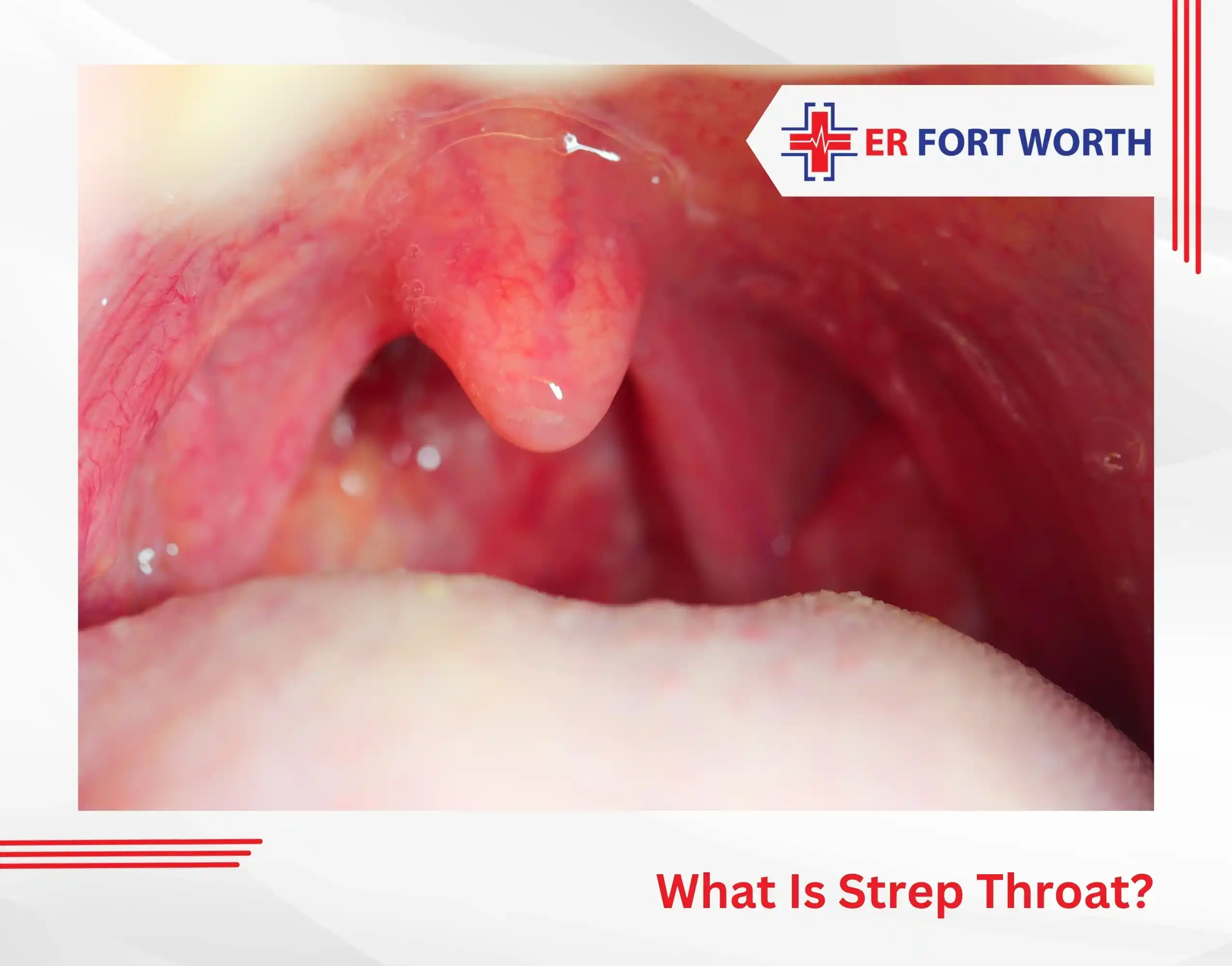 What Is Strep Throat