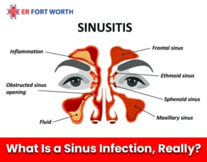 What Is a Sinus Infection, Really
