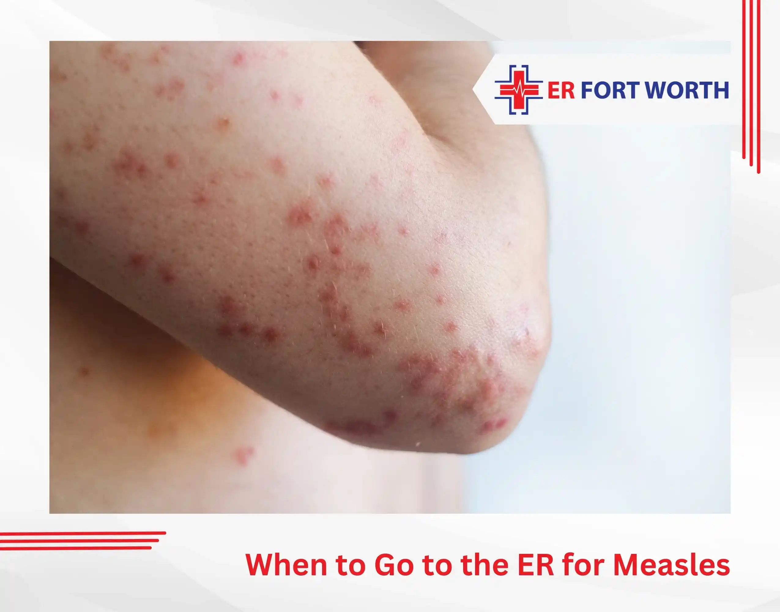 When to Go to the ER for Measles