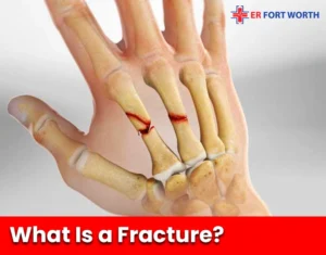 What Is a Fracture