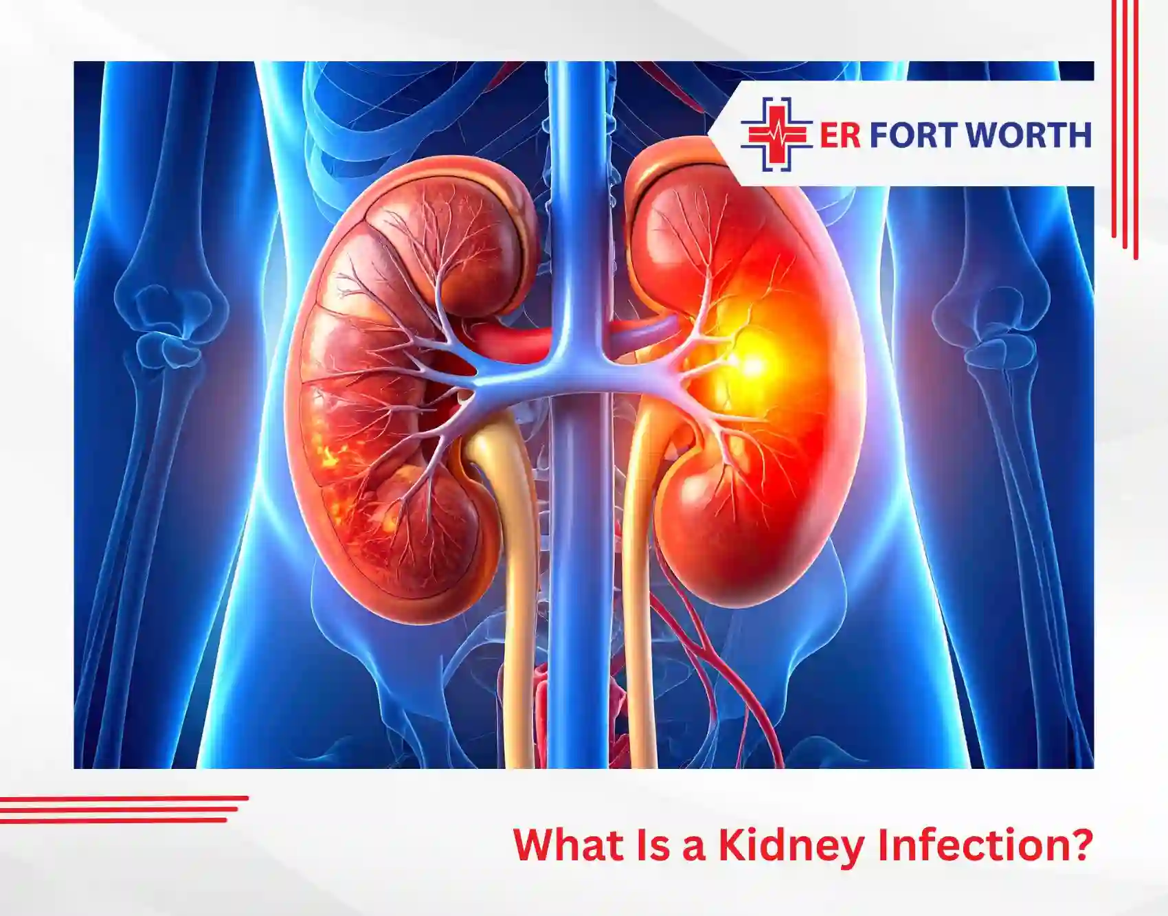 What Is a Kidney Infection