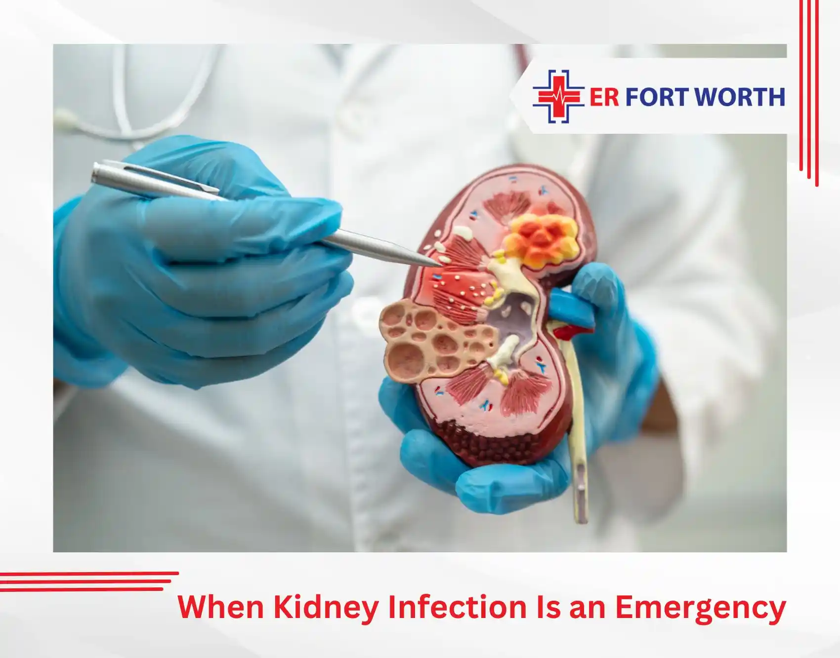 When Kidney Infection Is an Emergency