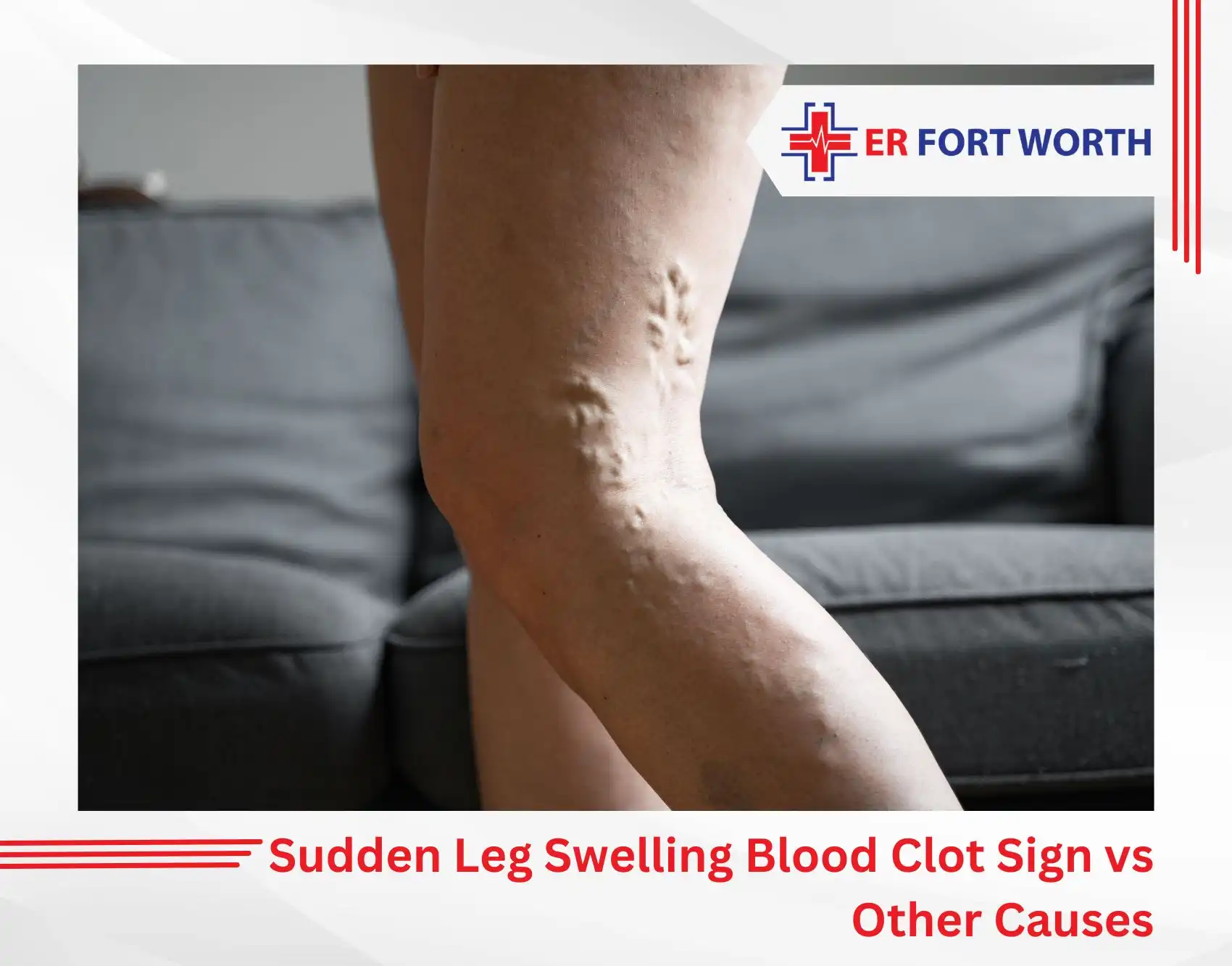 Sudden Leg Swelling Blood Clot Sign vs Other Causes