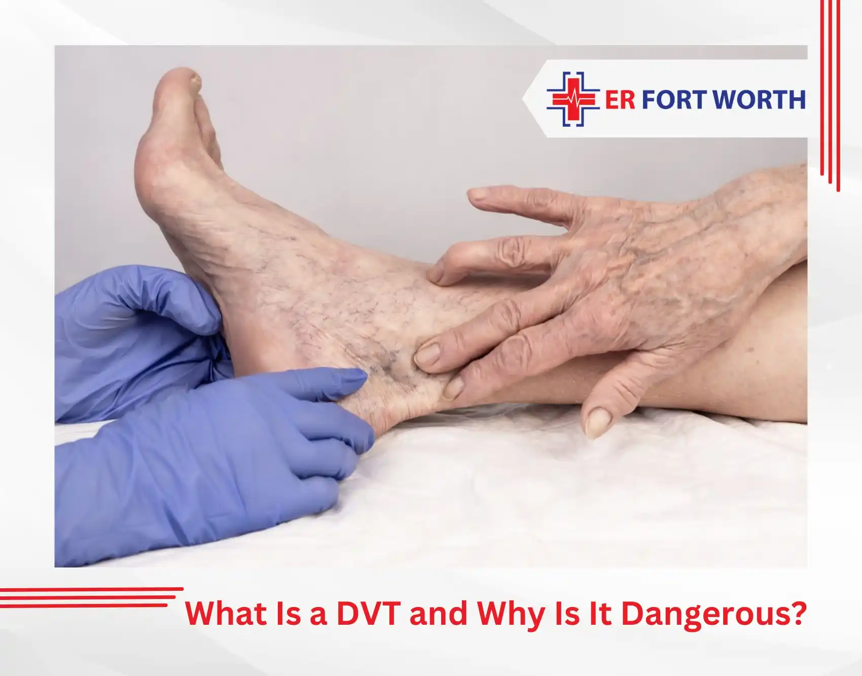 What Is a DVT and Why Is It Dangerous