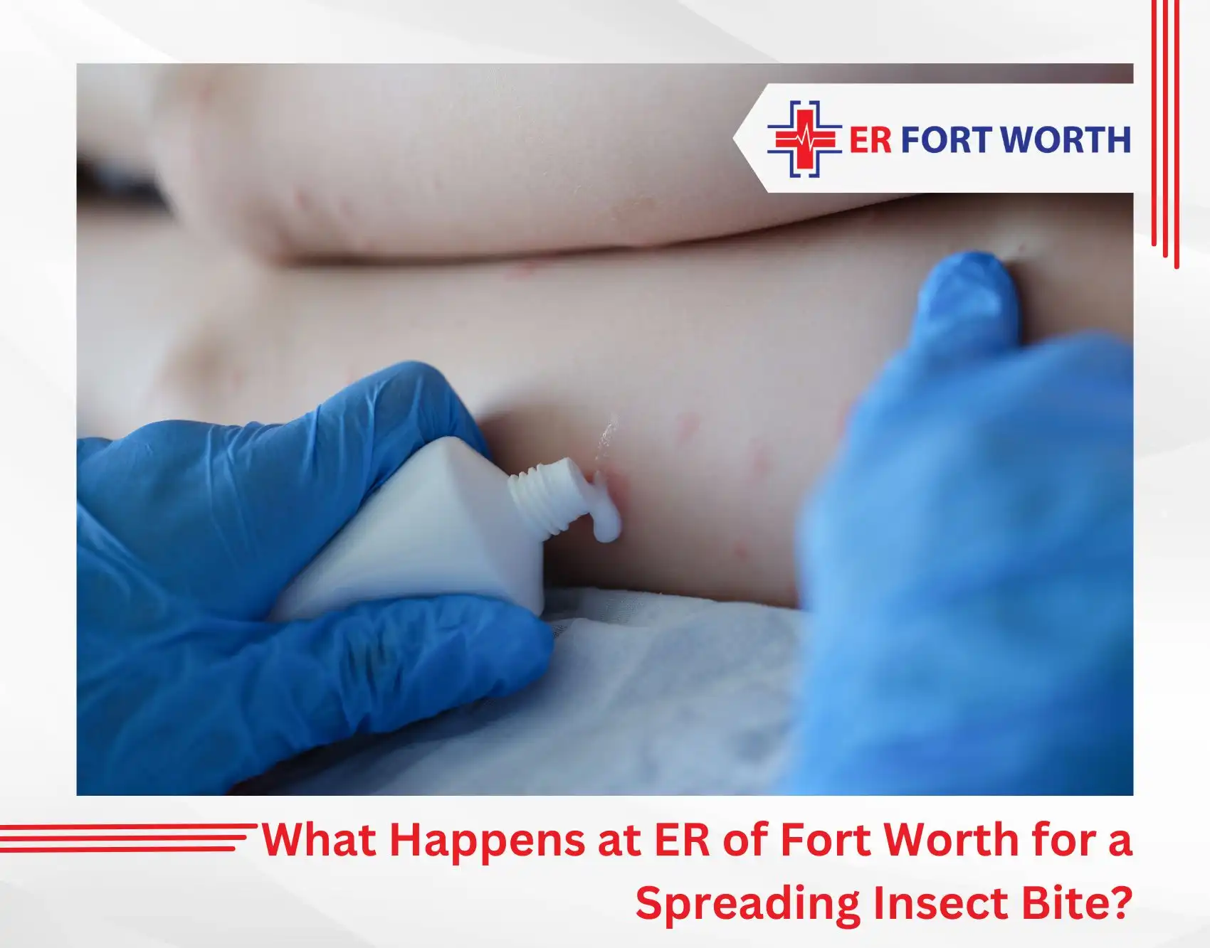 What Happens at ER of Fort Worth for a Spreading Insect Bite
